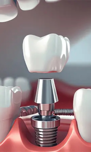 Dental Implants
